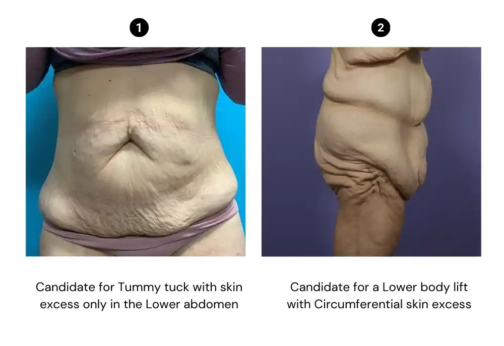 Candidate for Tummy Tuck (left) and Lower Body Lift (right)